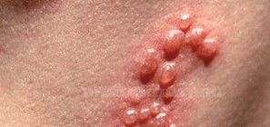 Cách nhận biết bệnh giang mai giai đoạn đầu
